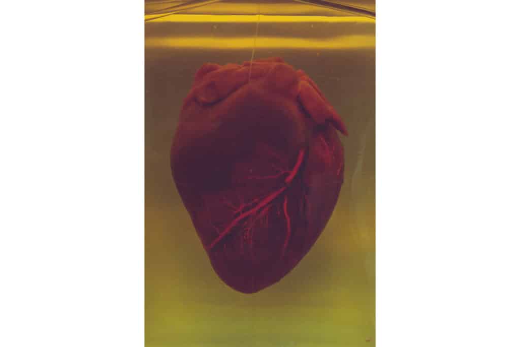 Extrasistole ventriculare - Cardio Clinic